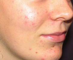 Accne